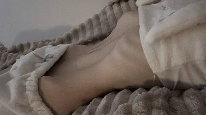 Cok zayifim karnimi icine cekince kaburgalarim cikiyor. Kimler böyle zayif?