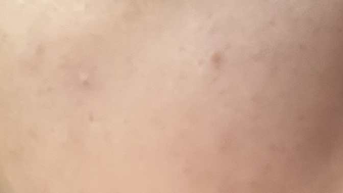 Yüzümdeki benleri geçirmek için etkili leke kremi önerir misiniz?