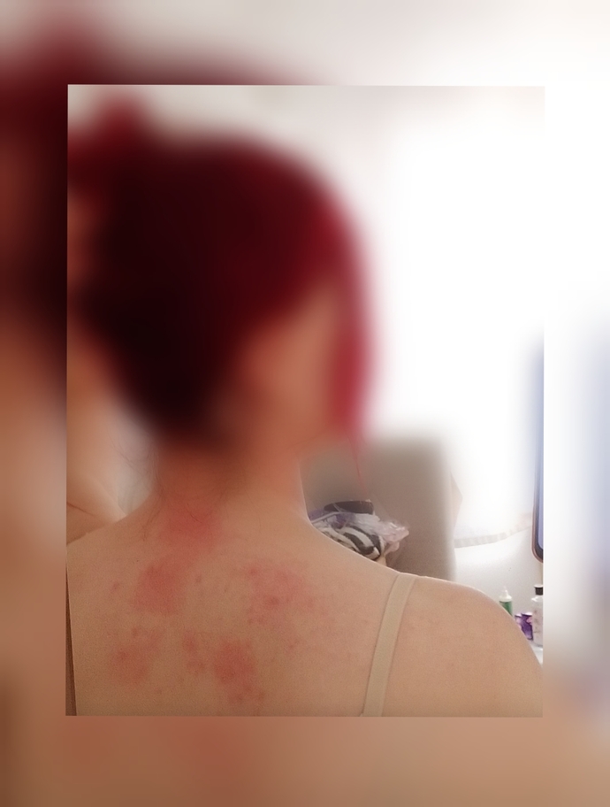 Ürtiker kurdeşen yaşayan var mı, kaşıntı ve stres için ne iyi gelir?