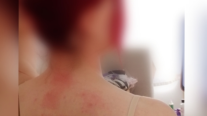 Ürtiker kurdeşen yaşayan var mı, kaşıntı ve stres için ne iyi gelir?