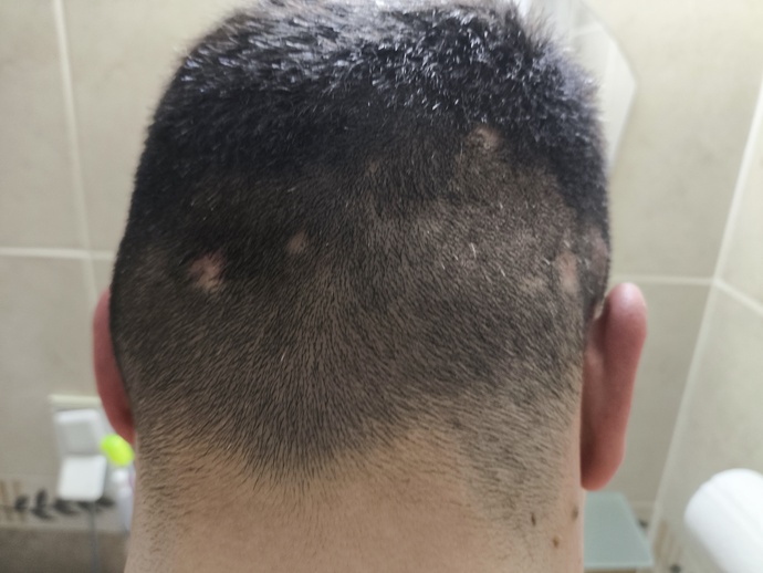 Sivilce yüzünden ense kısmında saç dökülmesi yaşadım, bu saçlar tekrar nasıl çıkar 😔?