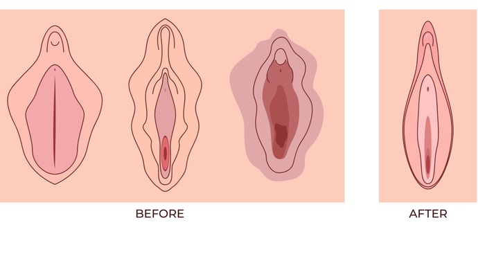 Genital estetik olan var mı?