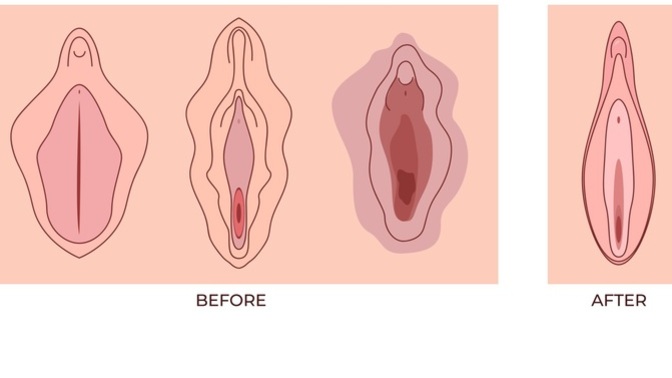Genital estetik olan var mı?