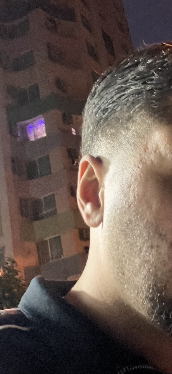 Kızlar, bir erkek düşünün ama cildinde bu şekilde izler var size göre yakışıklı sayılan biri ise bu izler sorun yaratırmı?