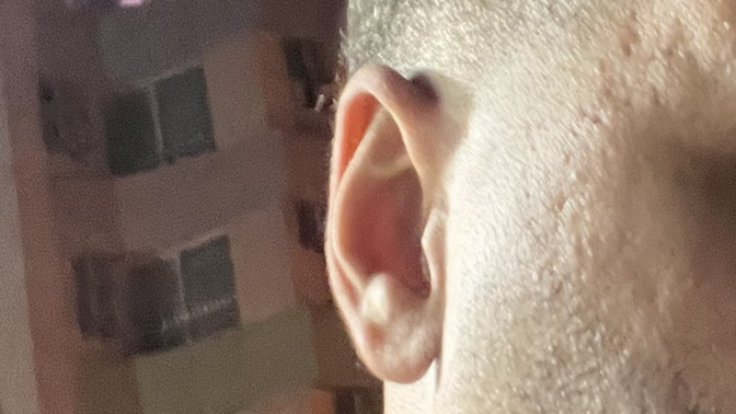 Kızlar, bir erkek düşünün ama cildinde bu şekilde izler var size göre yakışıklı sayılan biri ise bu izler sorun yaratırmı?