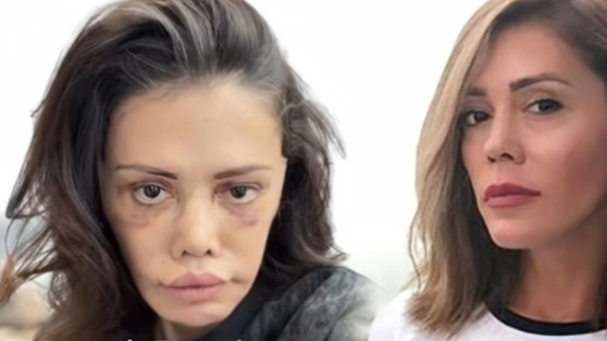 Güney korede estetik ameliyatı olan bu kadının son halini nasıl buldunuz?