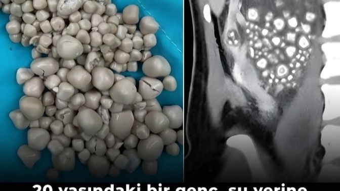 Bira bobrek taşı düşürüyorsa aslansütü ağrı kesici mi ?