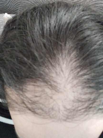 Kadınlarda Traksiyon Alopesisi saç dökülmesi nasıl geçer?