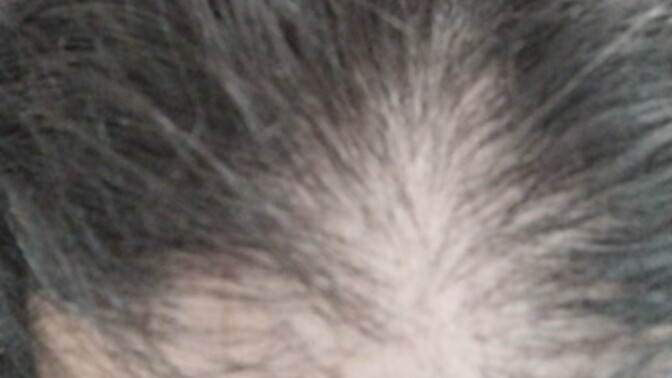 Kadınlarda Traksiyon Alopesisi saç dökülmesi nasıl geçer?