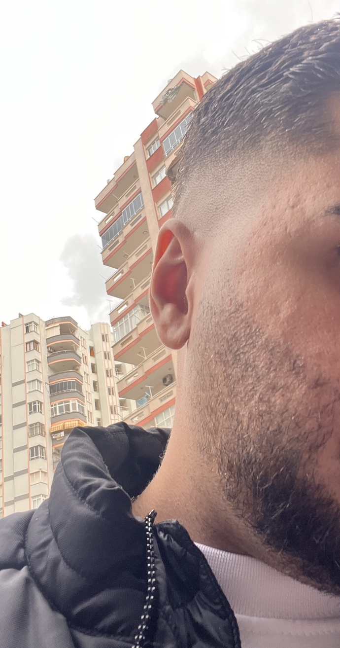 Kızlar, Kızlar için bir erkeğin yüzünde bu şekilde sivilce izi olması sorun olur mu, özgüvenimi çok zedeliyor?