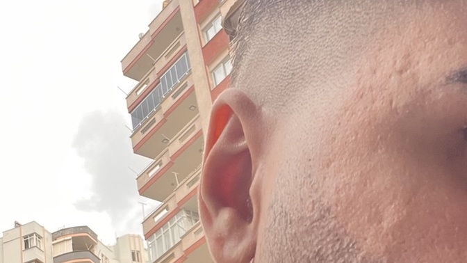 Kızlar, Kızlar için bir erkeğin yüzünde bu şekilde sivilce izi olması sorun olur mu, özgüvenimi çok zedeliyor?