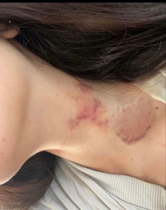 Boynumda böyle lekeler çıktı cildiye doktoru bakar mı?