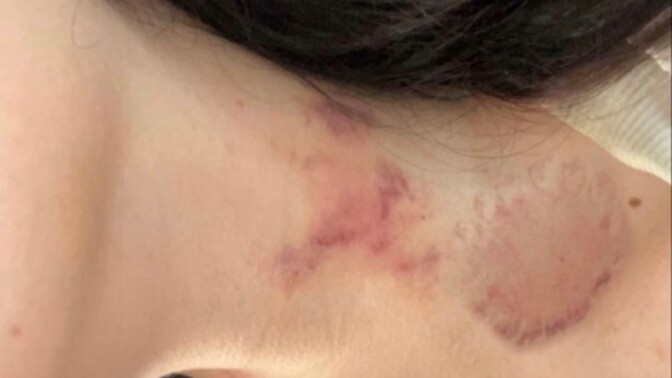 Boynumda böyle lekeler çıktı cildiye doktoru bakar mı?