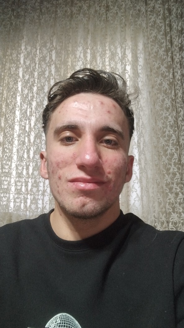 Göz kapağı düşüklüğü mü var?