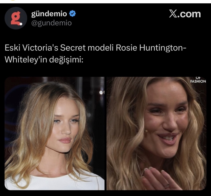 Güzeller güzeli Rosie Huntington-Whiteley estetik kurbanı oldu! Kadınlar neden böyle 😢 ?