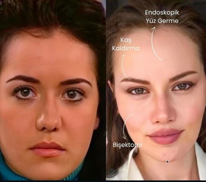 Yüzünüzde, estetik veya dolgu var mı?