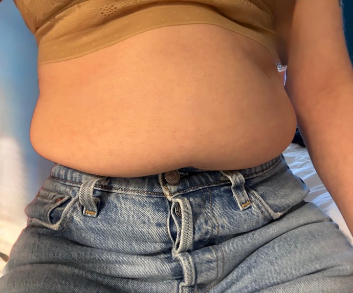 Kızlar, Zayıf kızlarda bazen böyle yemek sonrası şişen göbek olması normal mi bu ne patlayacak gibi duruyor?