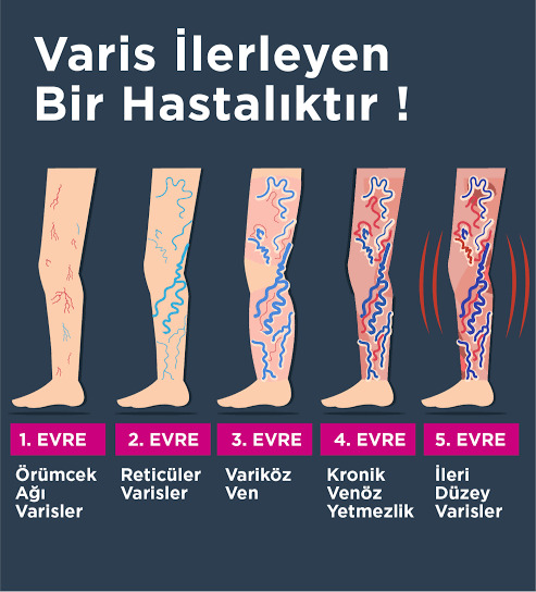 Varis ameliyatı olanlar anlatsın: riskleri, ağrısı, iyileşme süreci ve anestezi nasıldı?