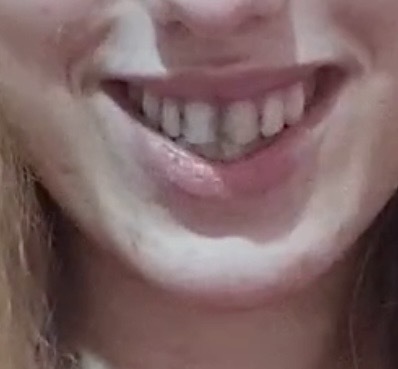 Zirkonyum kaplama dişlerim gerçek gibi mi?