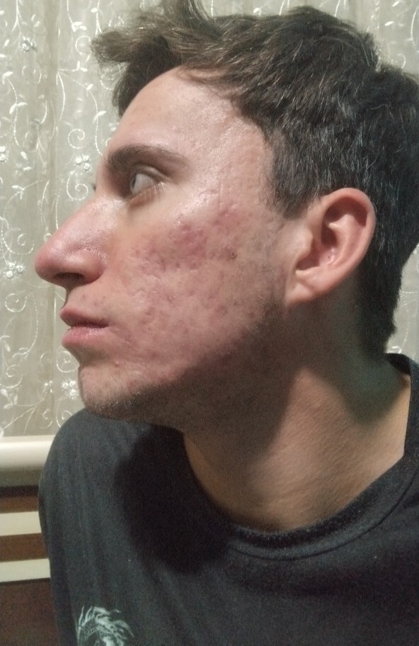 Burun estetiği olmayı düşünüyorum?