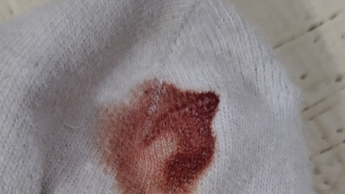 Serçe ayak parmağım kanadı nedeni ne sizce bir yere gidip geldim eve bir baktım ki kanamis?