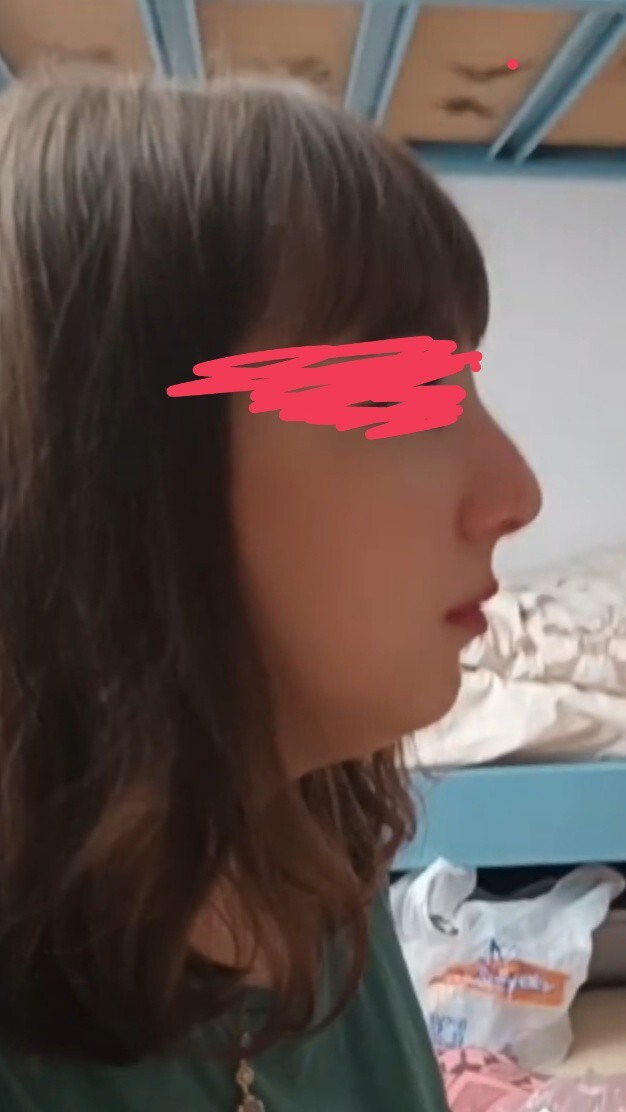 Rinoplasti olmak istiyorum ama kimi görsem burun delikleri eşit olmuyor ne yapmalıyım?