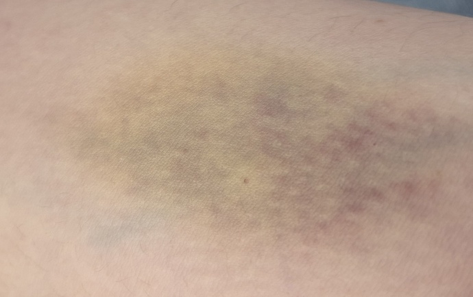 Cuma günü kan verdim 6 tüp kan alındı kolum resimdeki gibi oldu, nasıl geçer?