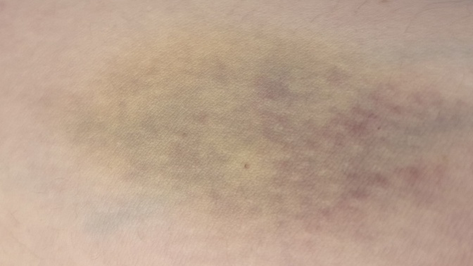 Cuma günü kan verdim 6 tüp kan alındı kolum resimdeki gibi oldu, nasıl geçer?