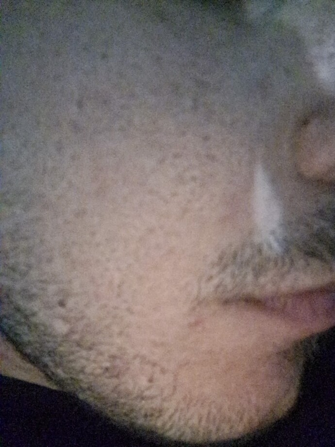 Burnunun üzerindeki siyah noktayı sıkayim dedim kan oturdu böyle kırmızı ben gibi duruyor çok rahatsız oldum? Nasıl geçer ki?