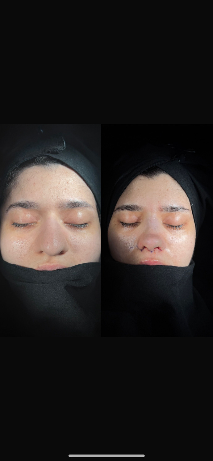Burun estetiği sonrası burnum fotolarda çok küçük duruyor, sizce doğal mı olmuş?