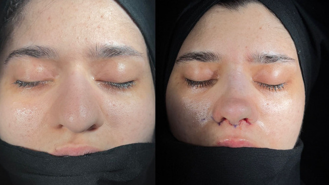 Burun estetiği sonrası burnum fotolarda çok küçük duruyor, sizce doğal mı olmuş?