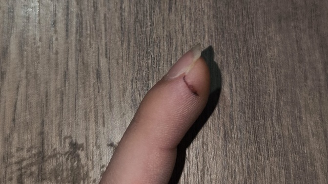Elimi bıçakla kestim 1 aydır tam iyileşmedi, parmak ucum soğuk ve uyuşuk, sinir hasarı mı var ne yapmalıyım?