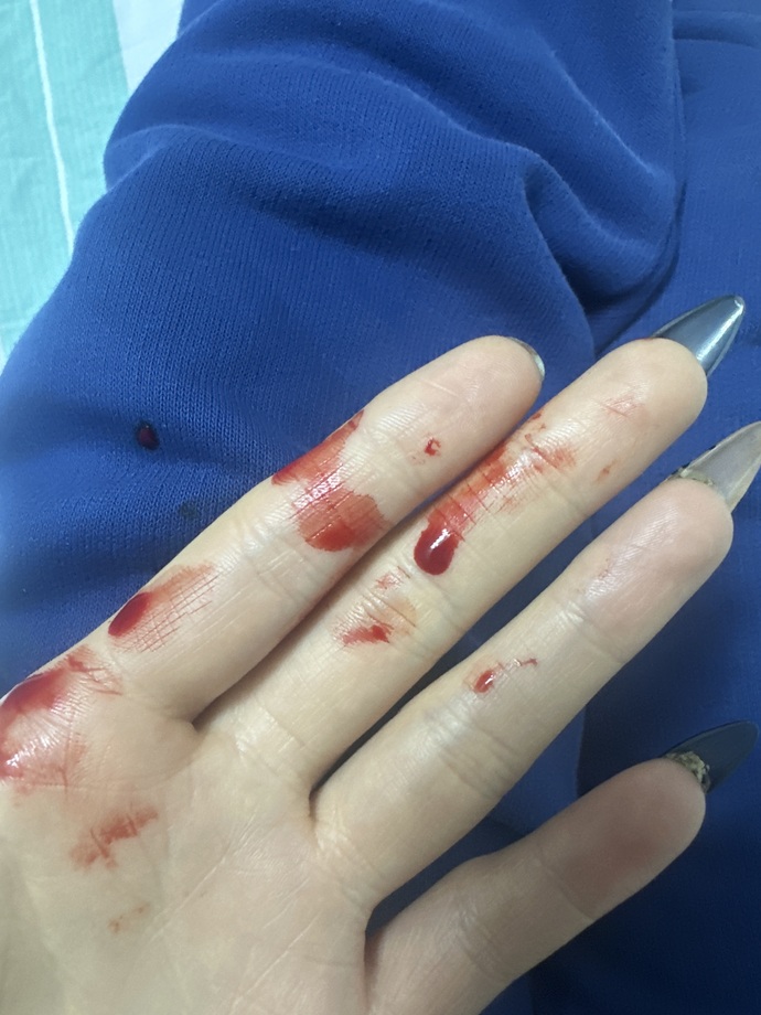 Burnumdaki damarı tirnagim yüzünden çok kötü patlattım bişey olur mu😭?