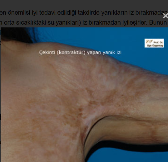 Omzumdaki yanık izi yüzünden askılı giymeye utanmam normal mi, dövme ile kapatmalı mıyım?