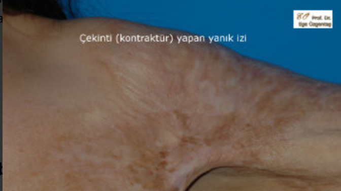 Omzumdaki yanık izi yüzünden askılı giymeye utanmam normal mi, dövme ile kapatmalı mıyım?