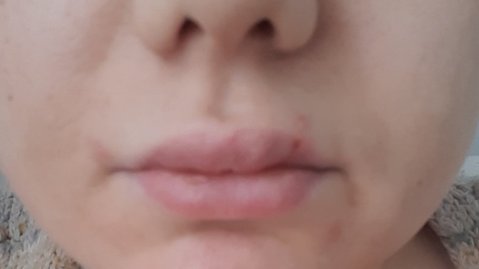 Dudağıma dolgu yaptirsam mı?