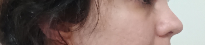 Burun estetiği sonrası 6 ay geçti, burnum hala eğri görünüyor sizce normal mi?