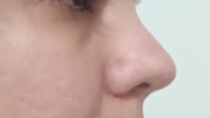 Burun estetiği sonrası 6 ay geçti, burnum hala eğri görünüyor sizce normal mi?