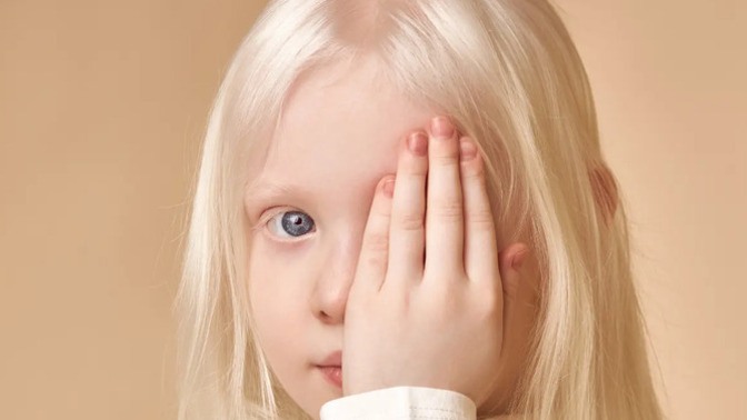 Albino insanlar büyüleyici bir güzelliğe sahip değil mi?