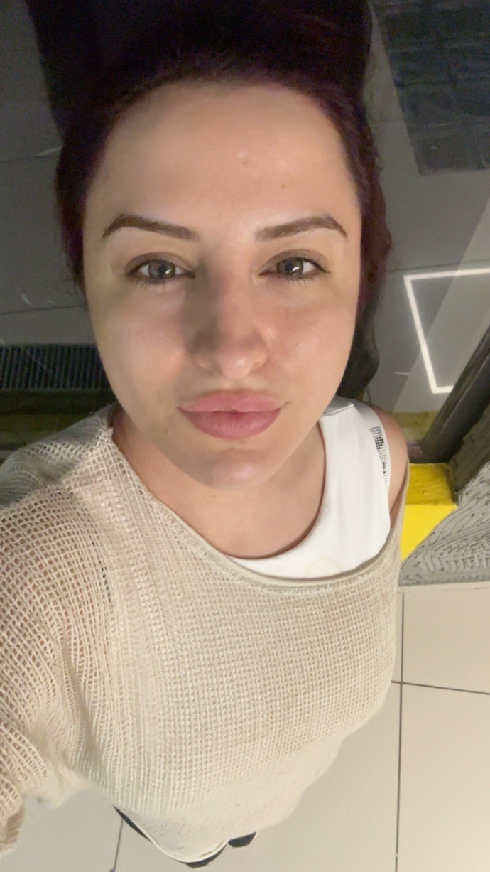 Yeni yaptırdığım mezoterapi cildime iyi gelmiş mi, sizce sonuç nasıl görünüyor?