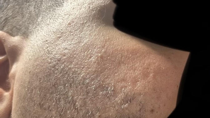 Kızlar, Cildimde bu şekilde sivilce izleri var çok moralimi bozuyor objektif olarak çok ku kötü yoksa normal mi?