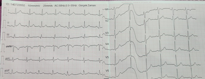 Aşırı göğüs ağrısı, haksızlık ve nefes darlığı ile hastaneye gittim, ekg çekildi.