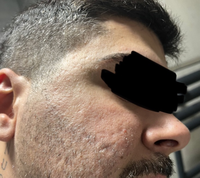 Kızlar, Cildinde bu şekilde izler olan ama size göre yakışıklı sayılan birinde bu izler sorun olur mu, çok mu kötü duruyor?