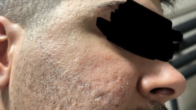 Kızlar, Cildinde bu şekilde izler olan ama size göre yakışıklı sayılan birinde bu izler sorun olur mu, çok mu kötü duruyor?