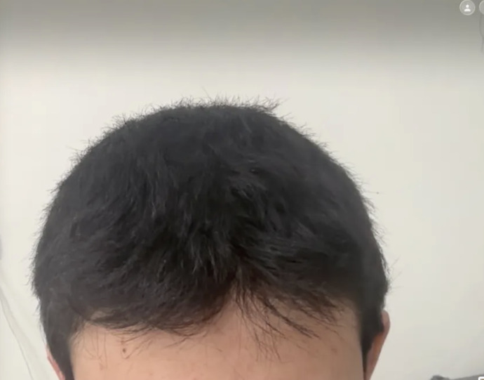 Sürekli kırılan saçlar için ne yapmalıyım, saç kırıkları nasıl tamamen geçer?