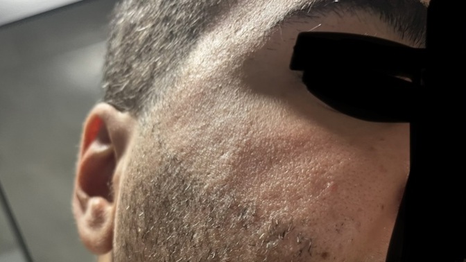 Cildimde bu şekilde sivilce izleri var özgüvenimi aşırı düşürüyor bir kız gözüyle baktığınızda çok mu rahatsız edici?