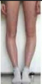 Yamuk Bacaklı Sevgili?