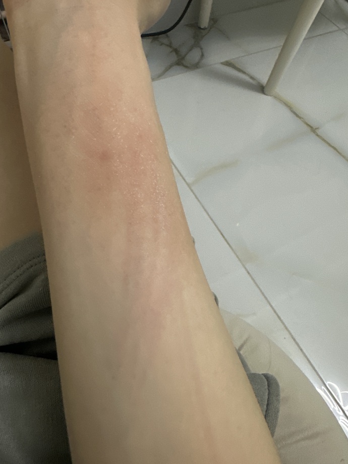 Uyuz mu alerji mi bu çok kaşınıyorum?