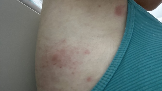 Uyuz mu alerji mi bu çok kaşınıyorum?