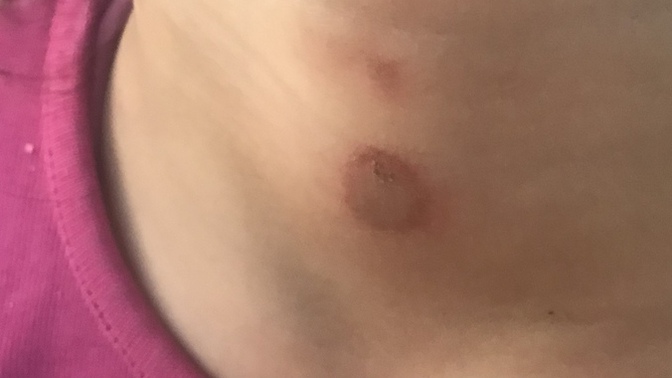 Kızımın boynuna sürdüğü deodorant sonrası geçmeyen leke ve kızarıklık ne olabilir?